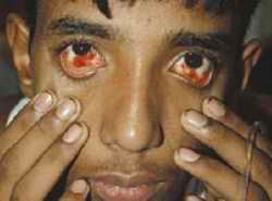 Dengue fever symptoms
