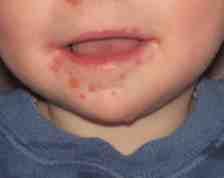 hand foot mouth disease